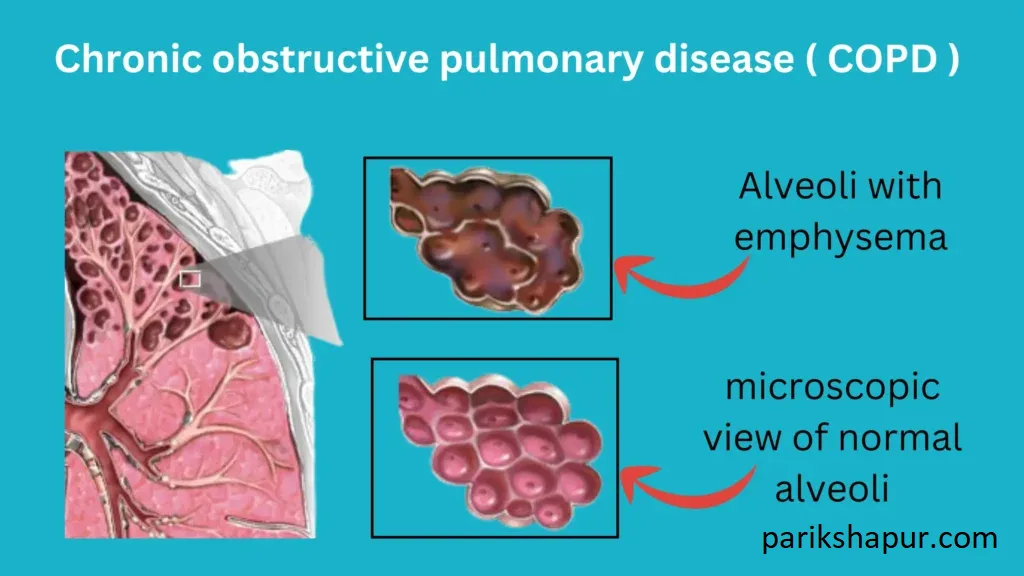 Chronic obstructive pulmonary disease – symptoms and treatment