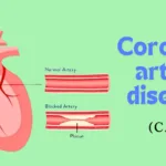 Coronary artery disease (CAD)