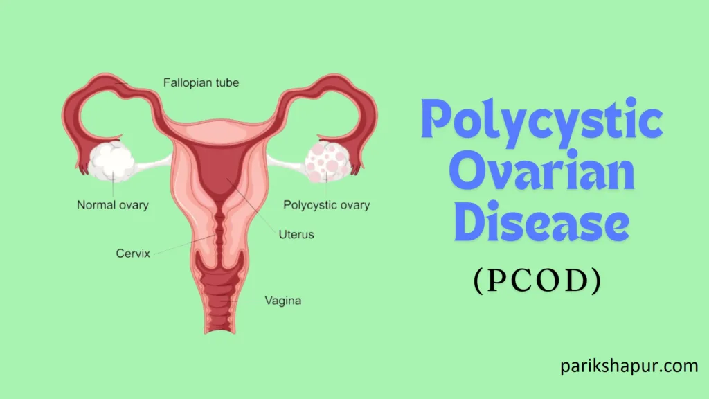 Polycystic Ovarian Disease (PCOD)