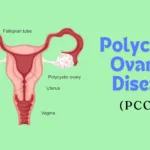 Polycystic Ovarian Disease (PCOD)