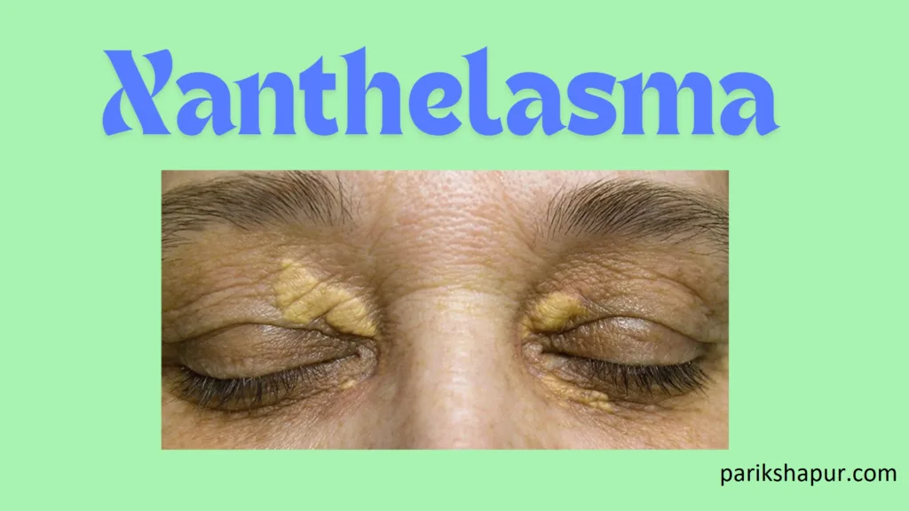 Xanthelasma: Symptoms and its treatment.