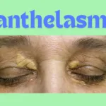 Xanthelasma: Symptoms and its treatment.